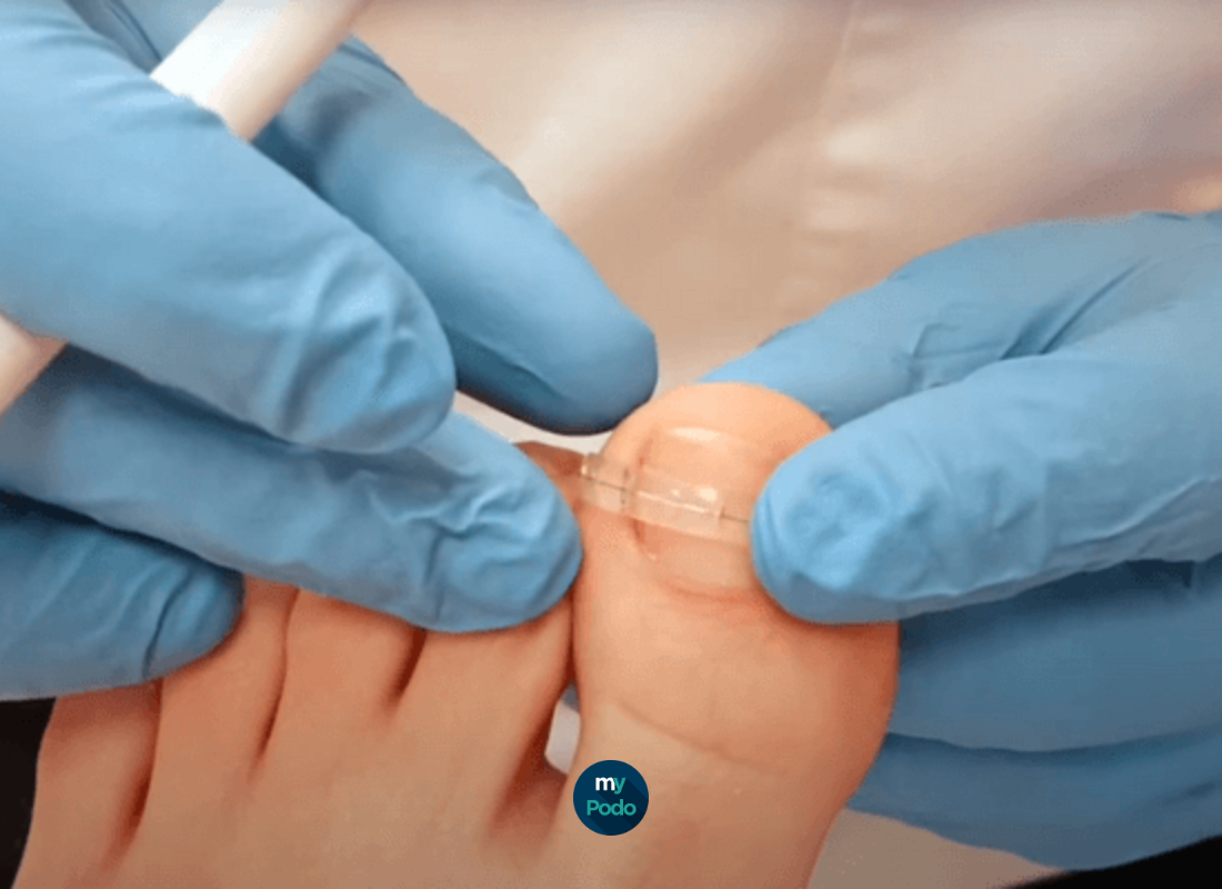 Tout sur la languette Bacquart - My Podologie